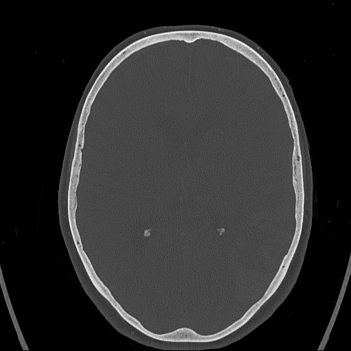 Cerebral venous infarction with hemorrhage (Radiopaedia 65343-74381 Axial bone window 97).jpg