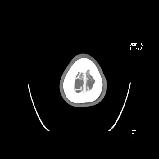 Cerebral venous infarction with hemorrhage (Radiopaedia 65343-74396 A 134).jpg
