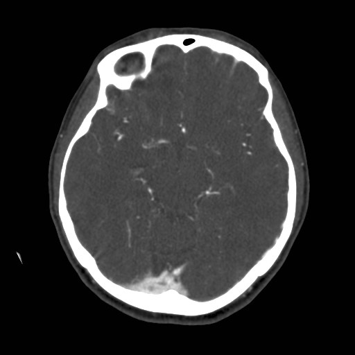 Cerebral venous sinus thrombosis (Radiopaedia 40619-43227 A 95).jpg