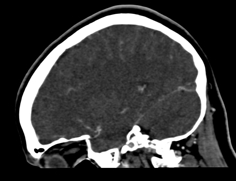 Cerebral venous sinus thrombosis (Radiopaedia 59224-66646 Sagittal C+ delayed 43).jpg
