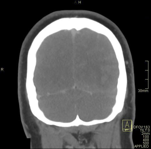 File:Cerebral venous sinus thrombosis (Radiopaedia 91329-108965 Coronal venogram 76).jpg