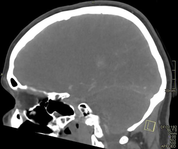 Cerebral venous sinus thrombosis (Radiopaedia 91329-108965 Sagittal venogram 46).jpg