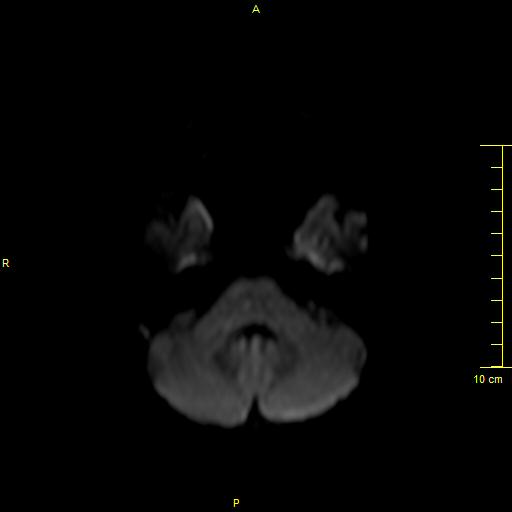 File:Cerebral venous thrombosis (Radiopaedia 23288-23351 Axial DWI 7).JPG