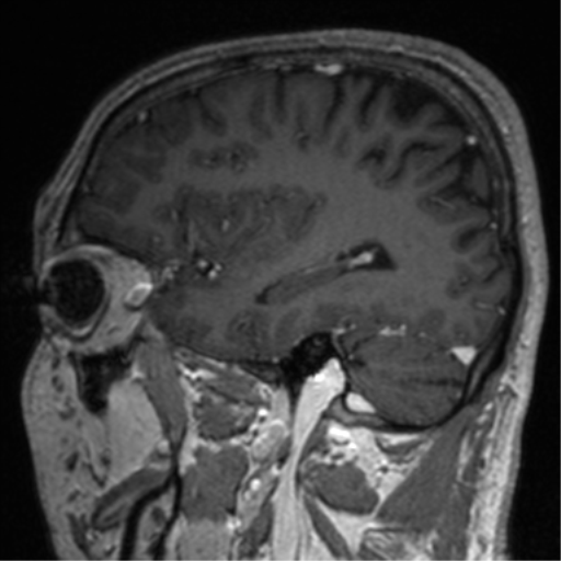 Cerebral venous thrombosis (Radiopaedia 38392-40469 Sagittal T1 C+ 63).png