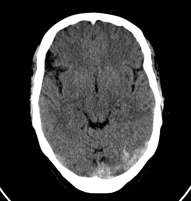 Cerebral venous thrombosis - CT only (Radiopaedia 41031-43778 Axial non-contrast 51).jpg