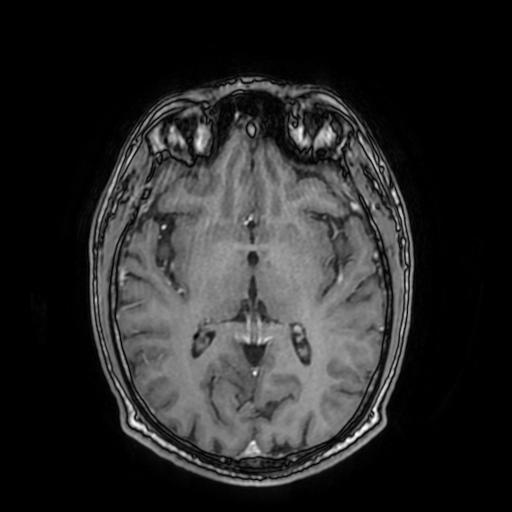 File:Cerebral venous thrombosis with secondary intracranial hypertension (Radiopaedia 89842-106957 Axial T1 C+ 95).jpg