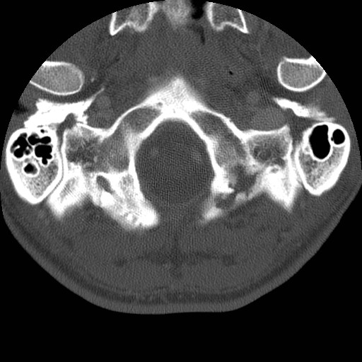 Cervical Pott disease (Radiopaedia 20374-20286 Axial bone window 10).jpg