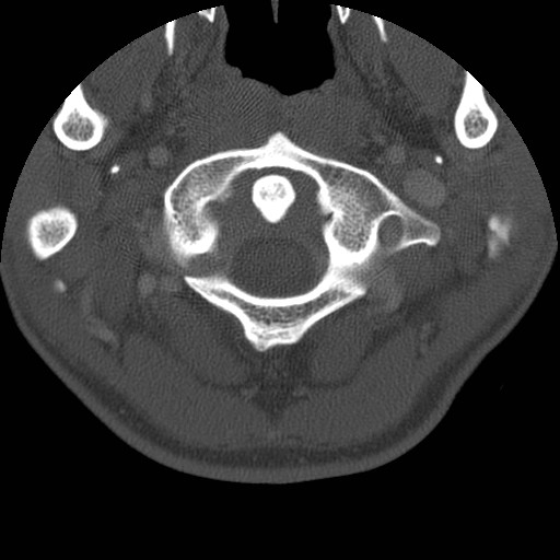 Cervical Pott disease (Radiopaedia 20374-20286 Axial bone window 20).jpg