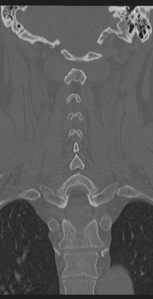 Cervical canal stenosis due to ossification of the posterior longitudinal ligament (Radiopaedia 47260-51823 Coronal bone window 40).png