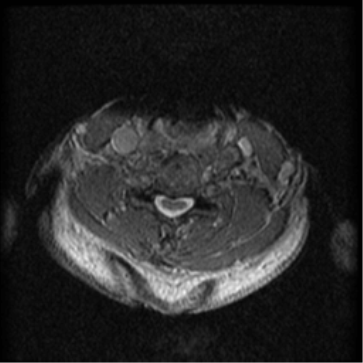 File:Cervical canal stenosis with cord compression (Radiopaedia 34114-35374 Axial Gradient Echo 39).png