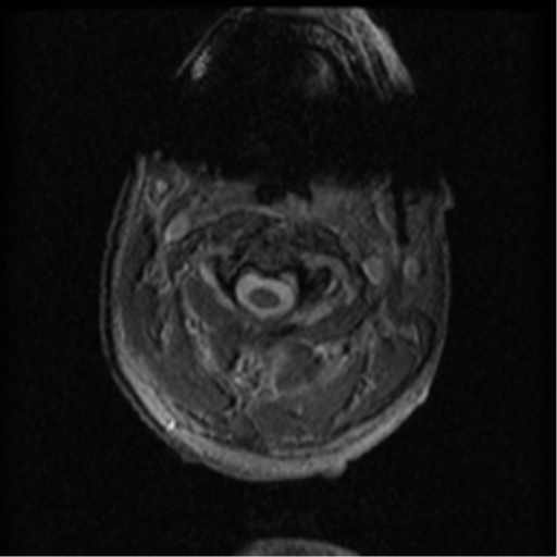 Cervical canal stenosis with cord compression (Radiopaedia 34114-35374 Axial Gradient Echo 81).png