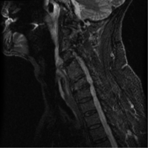 File:Cervical canal stenosis with cord compression (Radiopaedia 34114-35374 Sagittal STIR 5).png