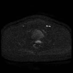 Cervical carcinoma (Radiopaedia 85405-101028 Axial DWI 66).jpg