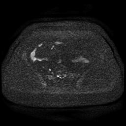 File:Cervical carcinoma (Radiopaedia 85405-101028 Axial DWI 79).jpg