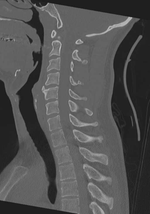 Cervical intercalary bone (Radiopaedia 35211-36748 Sagittal bone window 37).png