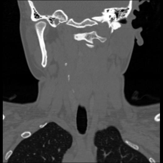 File:Cervical rib (Radiopaedia 71110-81363 Coronal non-contrast 31).jpg