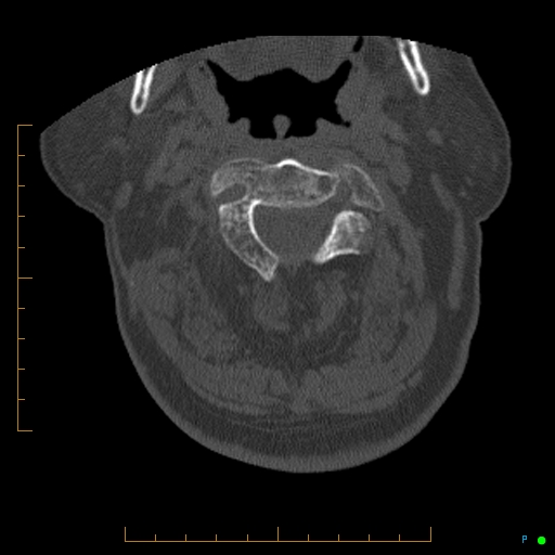 File:Cervical spine fracture - ankylosing spondylitis (Radiopaedia 76835-88706 Axial bone window 60).jpg