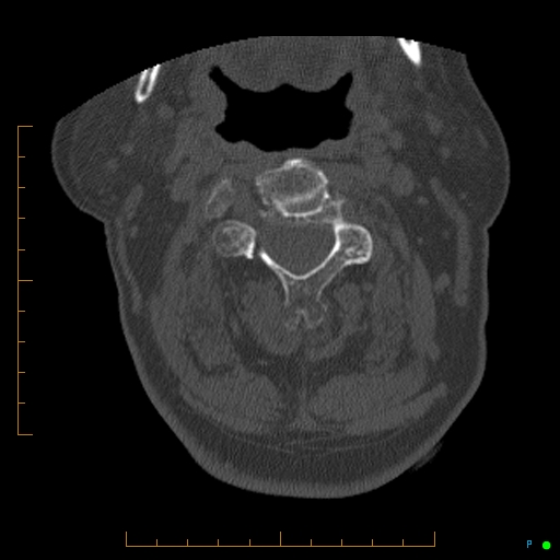 Cervical spine fracture - ankylosing spondylitis (Radiopaedia 76835-88706 Axial bone window 73).jpg