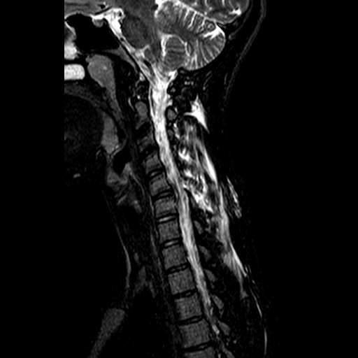 File:Cervical spine posterior ligamentous complex rupture (Radiopaedia 63486-72103 Sagittal STIR 5).jpg