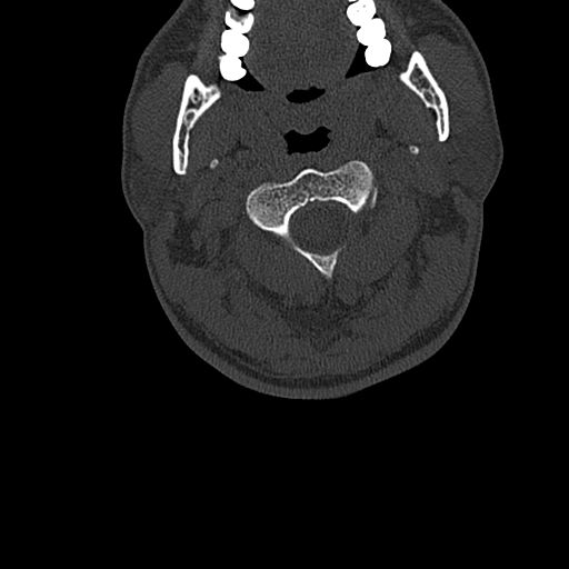 Cervical spine trauma with tear drop fracture and perched facet joint (Radiopaedia 53989-60127 Axial bone window 33).jpg