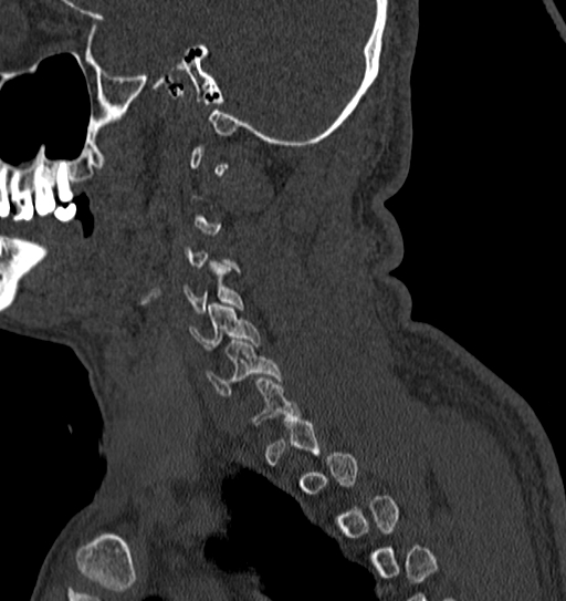 Cervical spine trauma with tear drop fracture and perched facet joint (Radiopaedia 53989-60127 Sagittal bone window 22).jpg