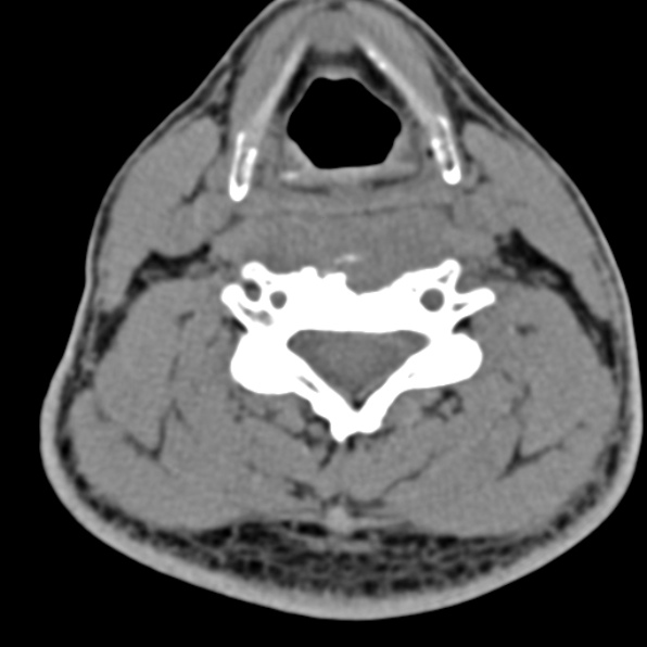 Cervical spondylodiscitis (Radiopaedia 28057-29489 Axial non-contrast 46).jpg