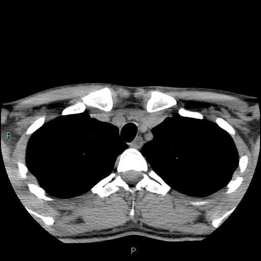 Cervical thymic cyst (Radiopaedia 88632-105335 Axial non-contrast 17).jpg
