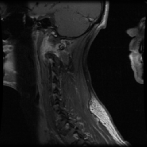 File:Cervical vertebrae metastasis (Radiopaedia 78814-91667 G 11).png