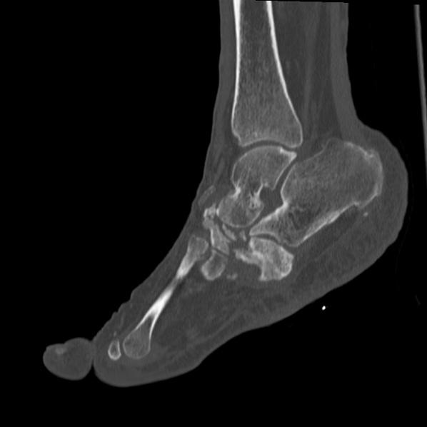 File:Charcot joint (Radiopaedia 36629-38194 Sagittal bone window 46).jpg