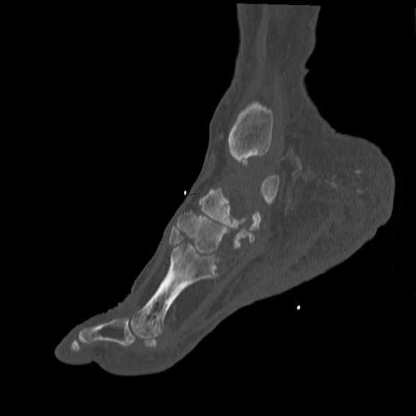 Charcot joint (Radiopaedia 36629-38194 Sagittal bone window 62).jpg