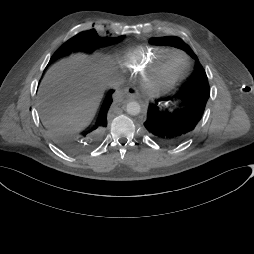 File:Chest multitrauma - aortic injury (Radiopaedia 34708-36147 A 219).png
