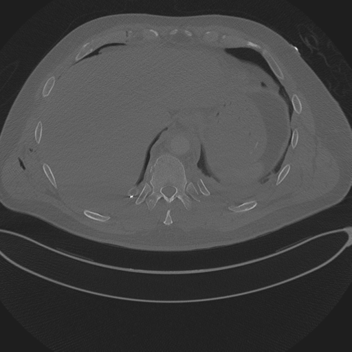 Chest multitrauma - aortic injury (Radiopaedia 34708-36147 Axial bone window 252).png