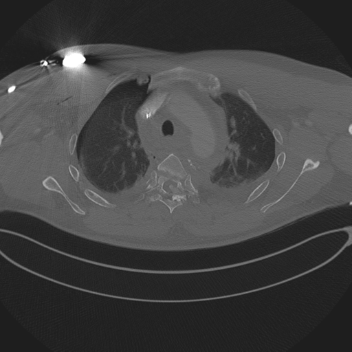 Chest multitrauma - aortic injury (Radiopaedia 34708-36147 Axial bone window 87).png