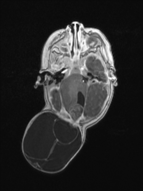 Chiari III malformation with occipital encephalocele (Radiopaedia 79446-92559 Axial T1 C+ mpr 37).jpg