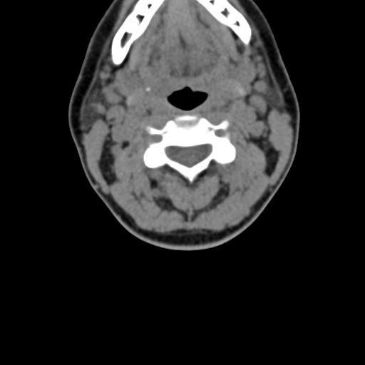 Chiari I malformation and obstructive hydrocephalus (Radiopaedia 41185-43981 D 45).png