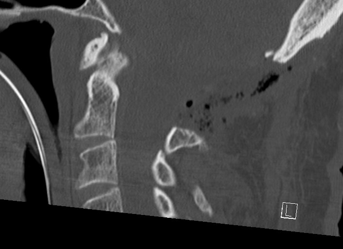 Chiari I malformation with a symptomatic syrinx of the posterolateral medulla oblongata (Radiopaedia 42573-45707 A 33).jpg