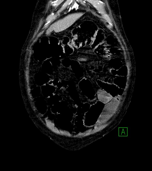 Cholangiocarcinoma with cerebral metastases (Radiopaedia 83519-98629 G 12).jpg