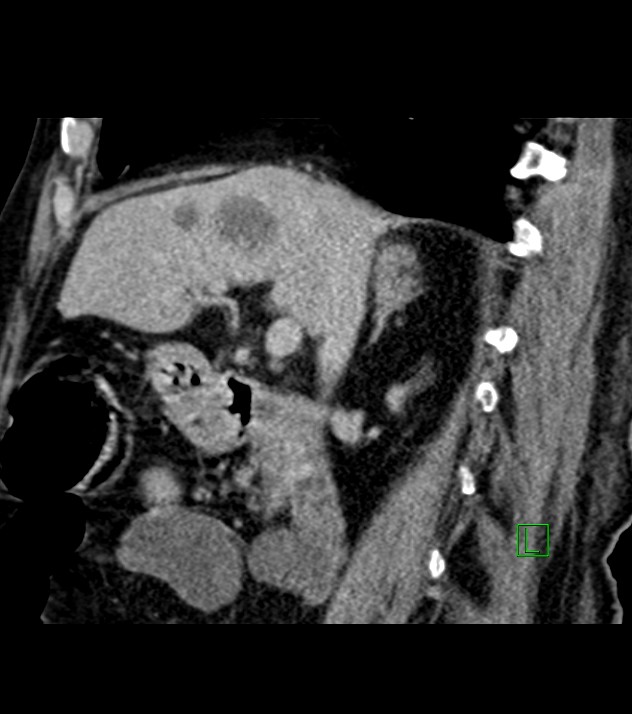 Cholangiocarcinoma with cerebral metastases (Radiopaedia 83519-98629 Sagittal C+ delayed 68).jpg