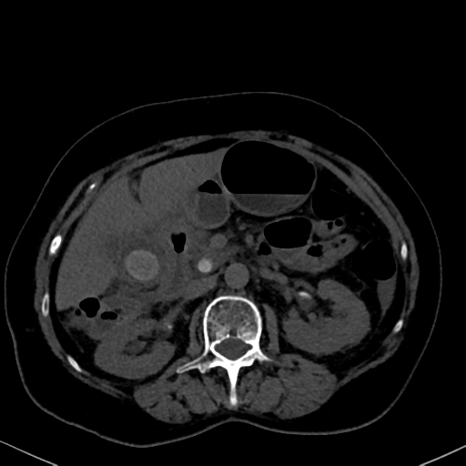 File:Cholecystitis - obstructive choledocholitiasis (CT intravenous cholangiography) (Radiopaedia 43966-47479 Axial 102).png