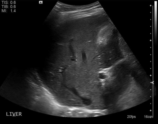 File:Cholecystitis - perforated gallbladder (Radiopaedia 57038-63913 A 3).jpg