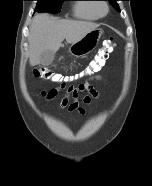 Cholecystitis with focal perforation and hepatic abscess (Radiopaedia 37189-38945 Coronal non-contrast 13).png