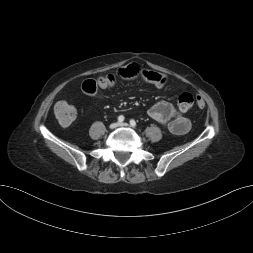 Cholecystoduodenal fistula due to calculous cholecystitis with gallstone migration (Radiopaedia 86875-103077 D 52).jpg
