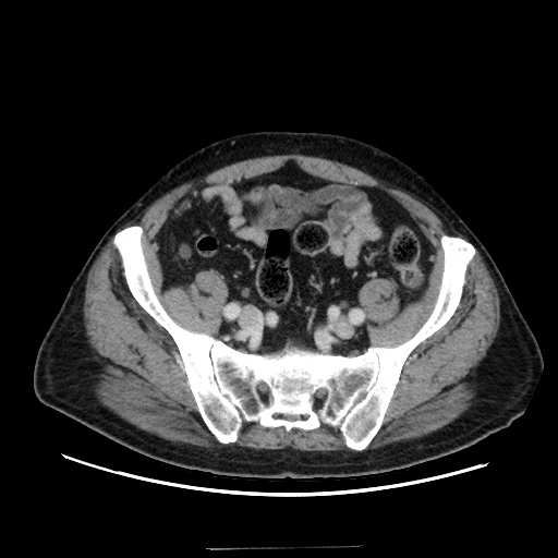 Choledocholiathiasis with normal caliber common bile duct (Radiopaedia 75368-86632 A 147).jpg