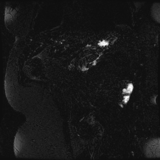 Choledocholithiasis on CT and MRI (Radiopaedia 24825-25088 Coronal T2 88).jpg