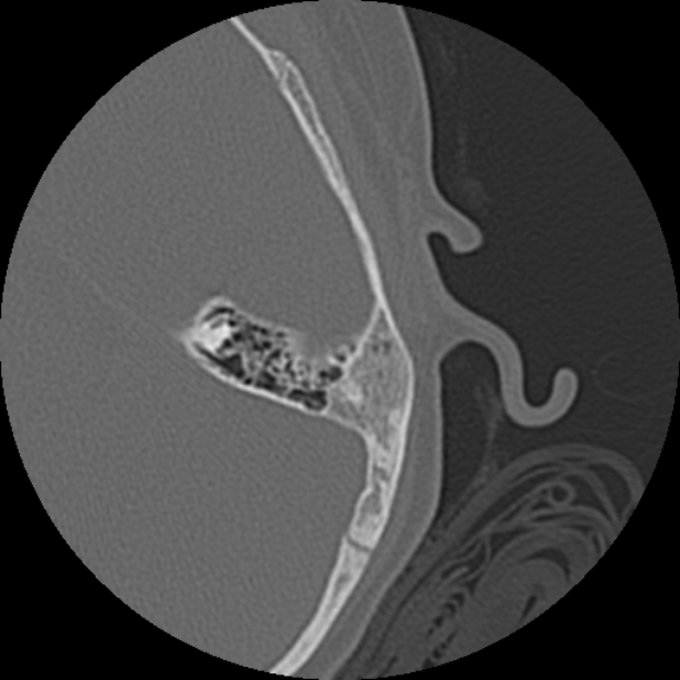 Cholesteatoma (Radiopaedia 73023-83750 Axial Left ear 72).jpg