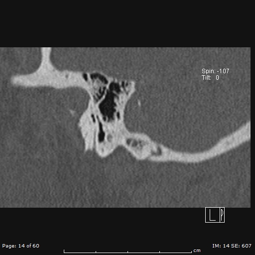 Cholesteatoma - external auditory canal (Radiopaedia 88452-105096 Sagittal bone window 14).jpg