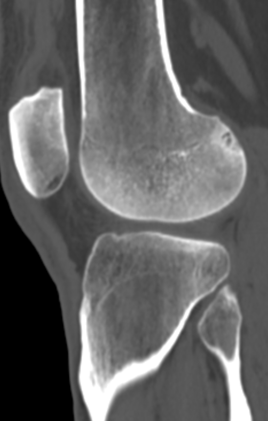 Chondrocalcinosis (Radiopaedia 82862-97173 Sagittal bone window 44).jpg