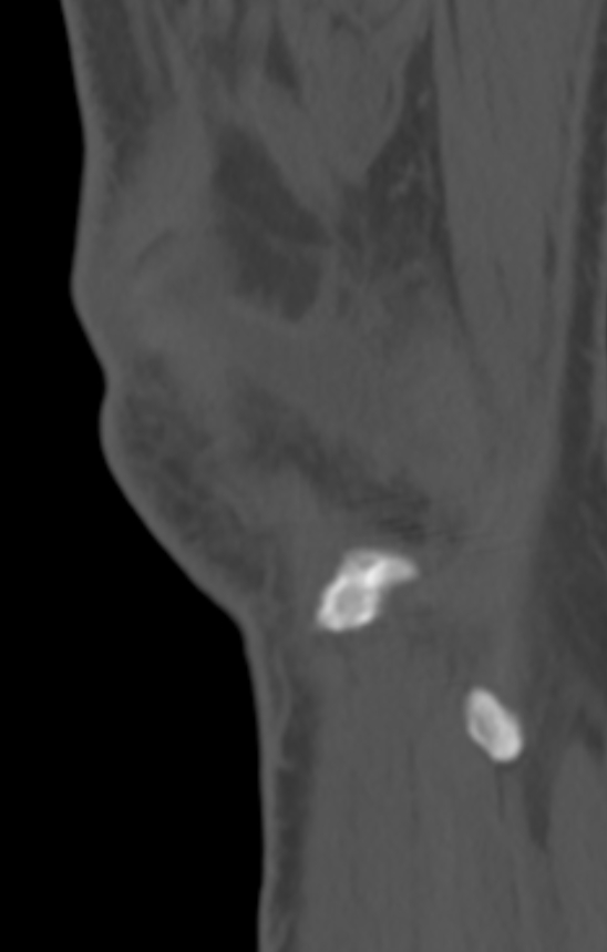 Chondrocalcinosis (Radiopaedia 82862-97173 Sagittal bone window 61).jpg