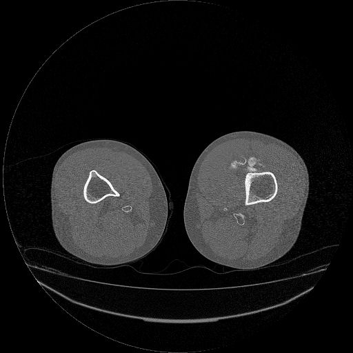 File:Chondrosarcoma arising from exostosis (Radiopaedia 59996-67507 Axial bone window 23).jpg