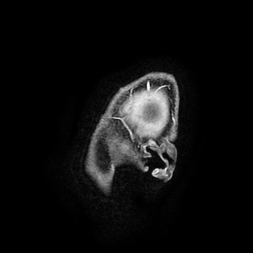 Chordoid glioma of third ventricle (Radiopaedia 91612-109340 F 14).jpg